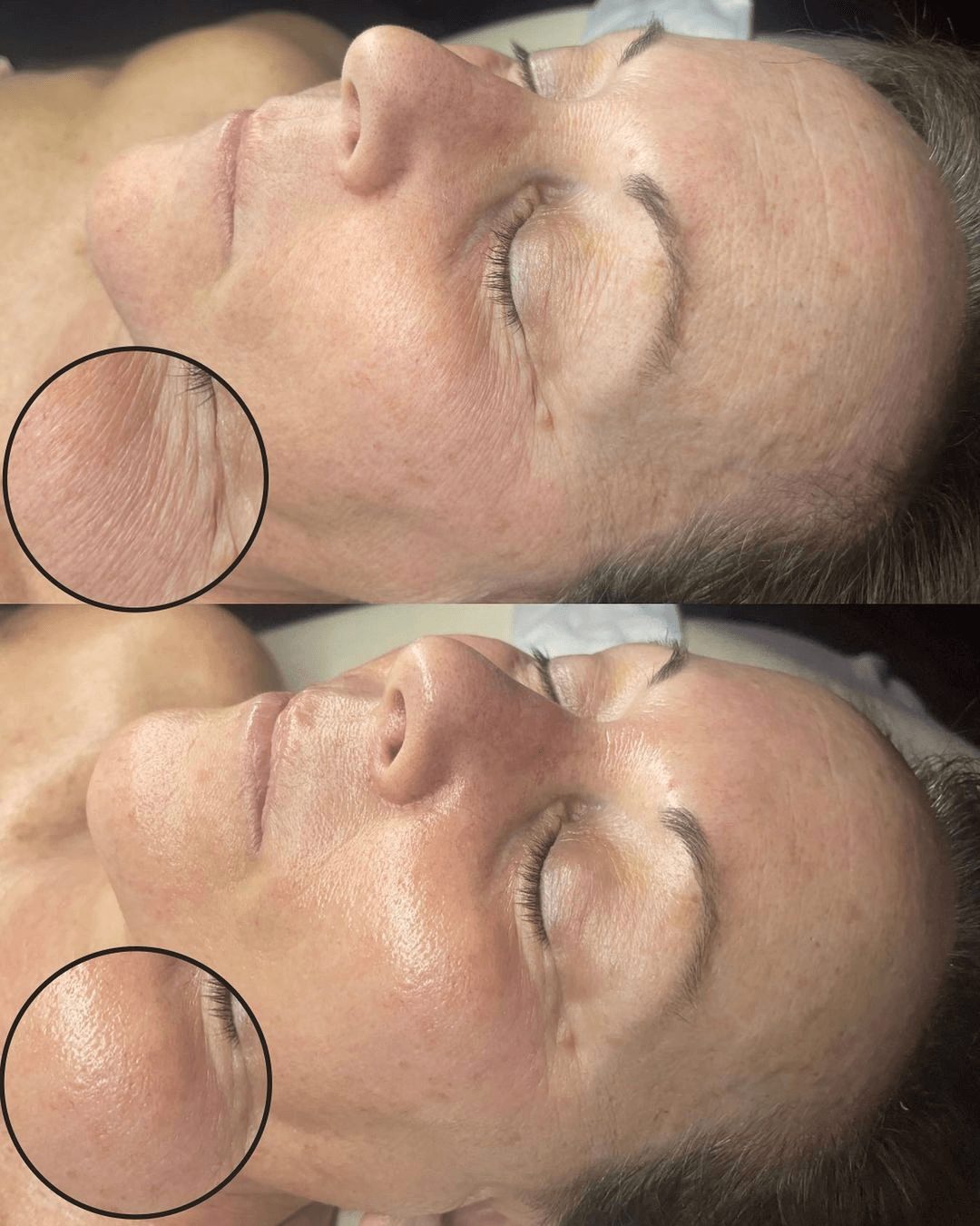 Comparație înainte și după bio-microneedling pentru aspectul liniilor fine