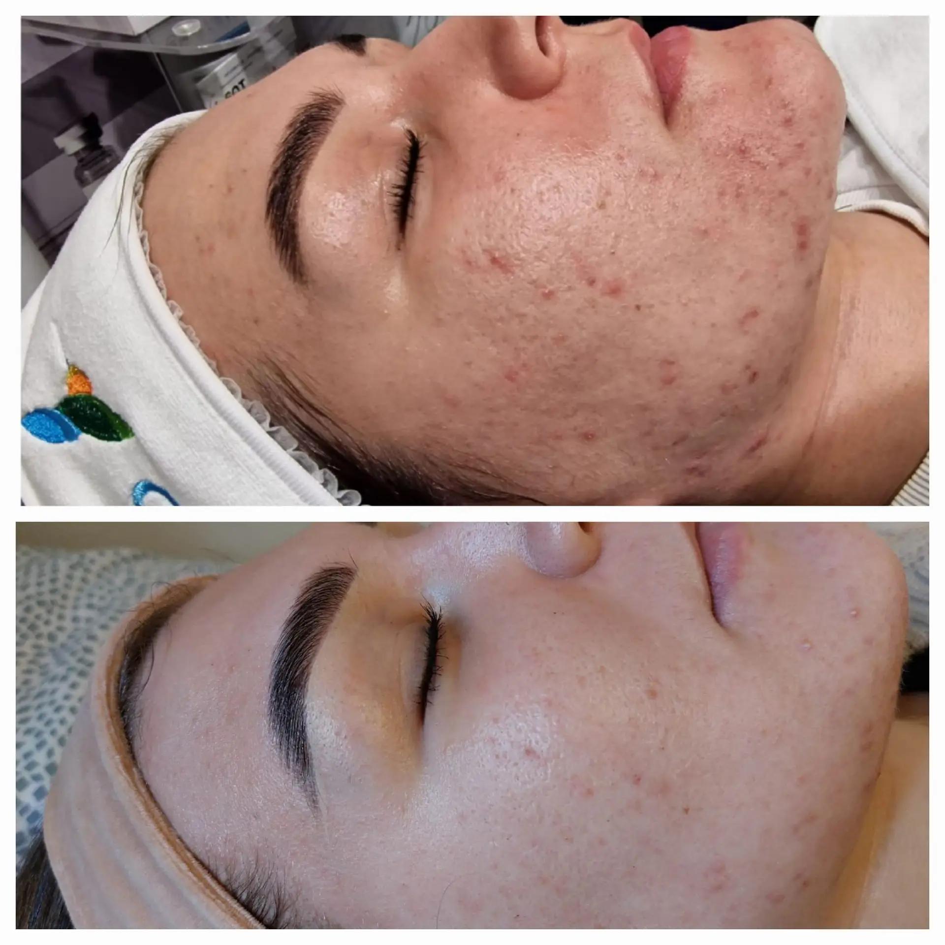 Comparație înainte și după tratamentul unui ten cu imperfecțiuni