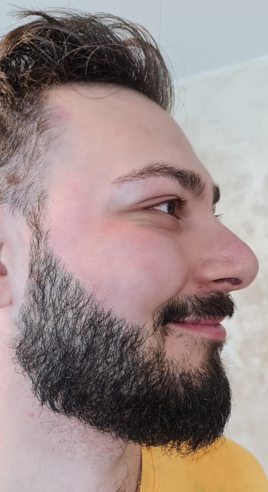 Epilare barbă obraji/gât