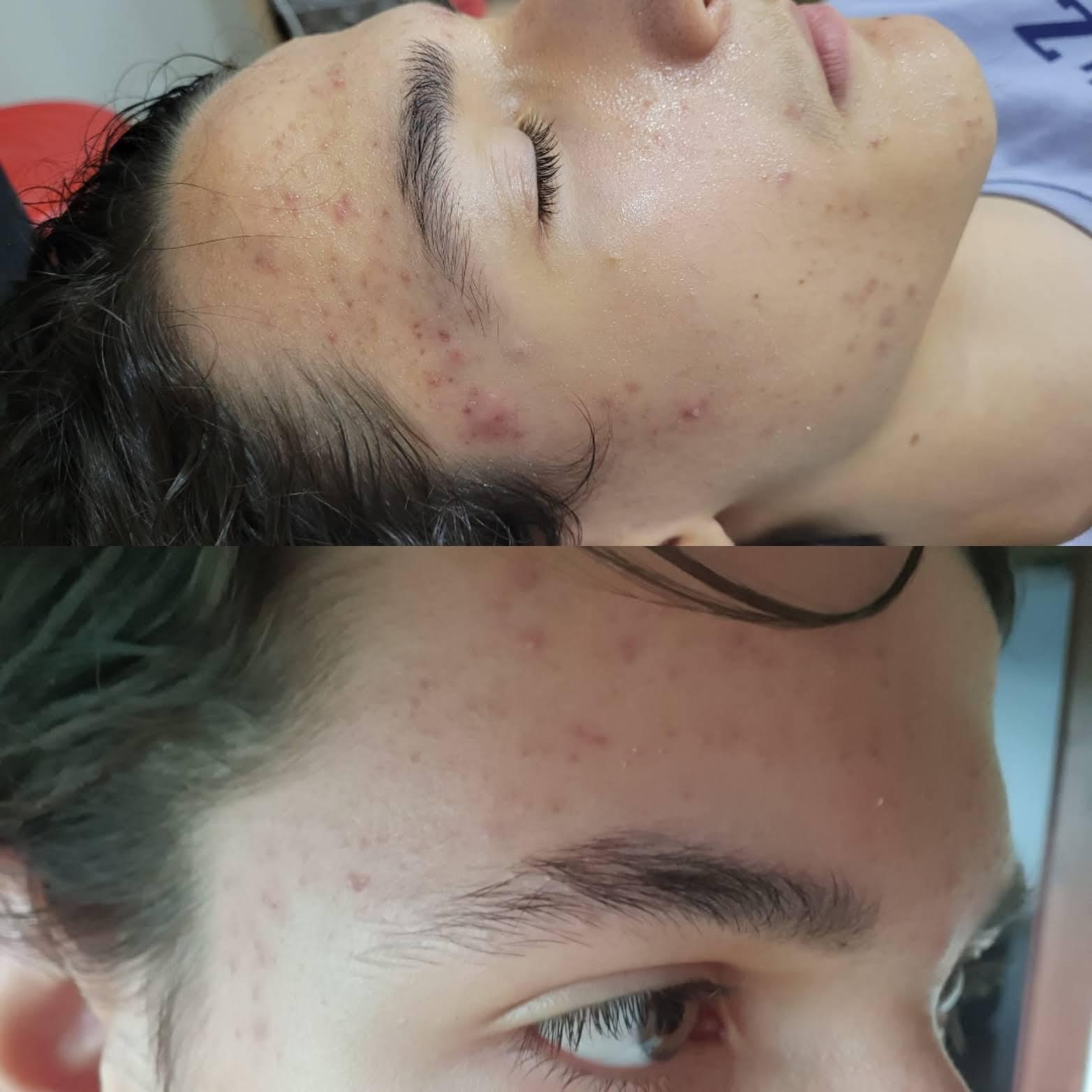 Tratament anti acnee